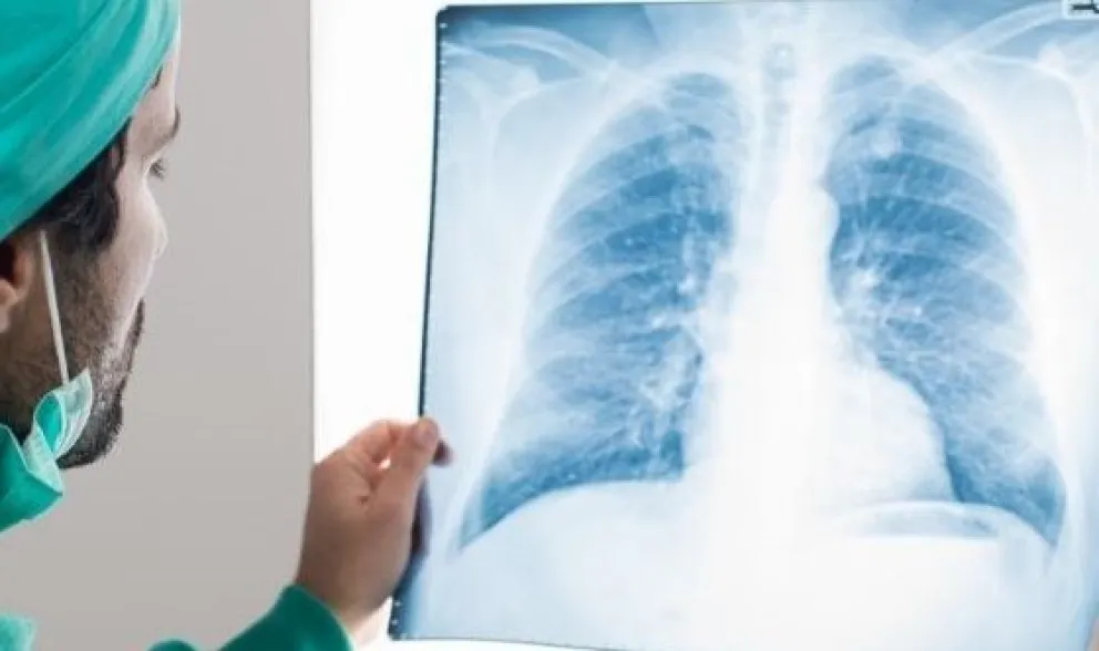 Argentina contará con un nuevo tratamiento para un tipo de cáncer de pulmón 